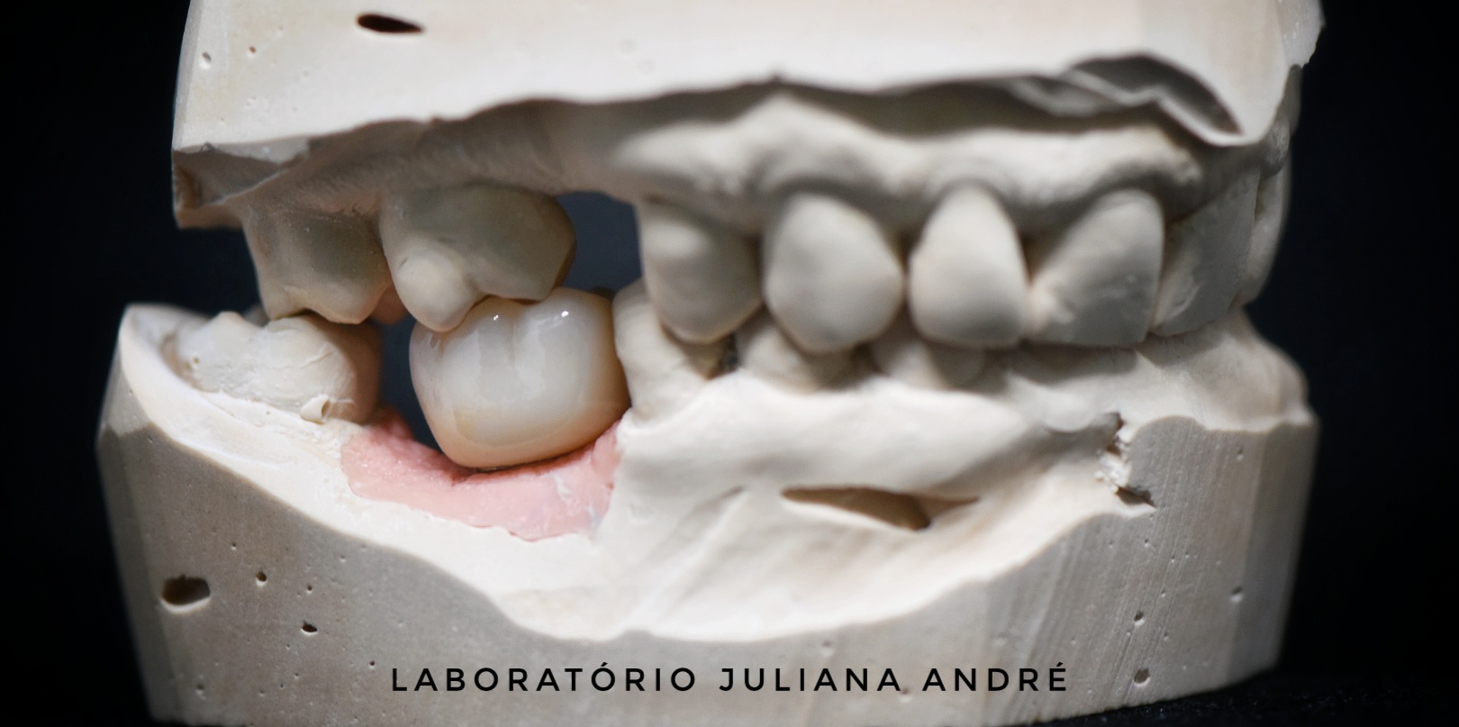 Coroa Zircónia sobre implante (2)