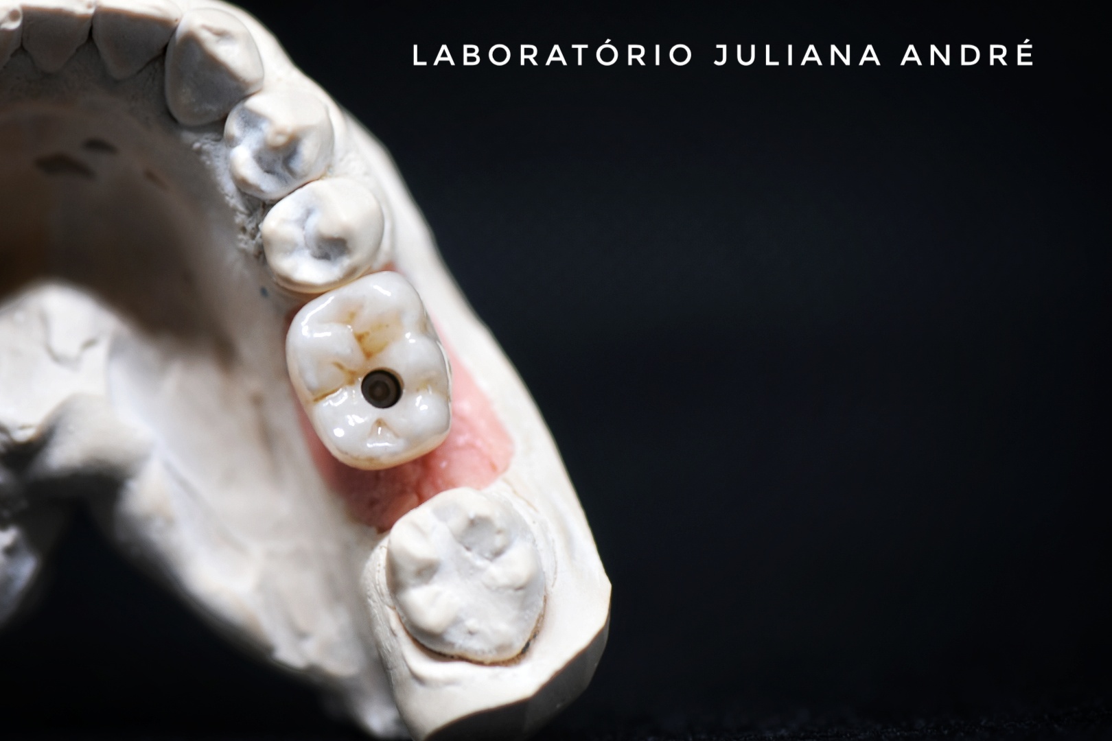 Coroa Zircónia sobre implante