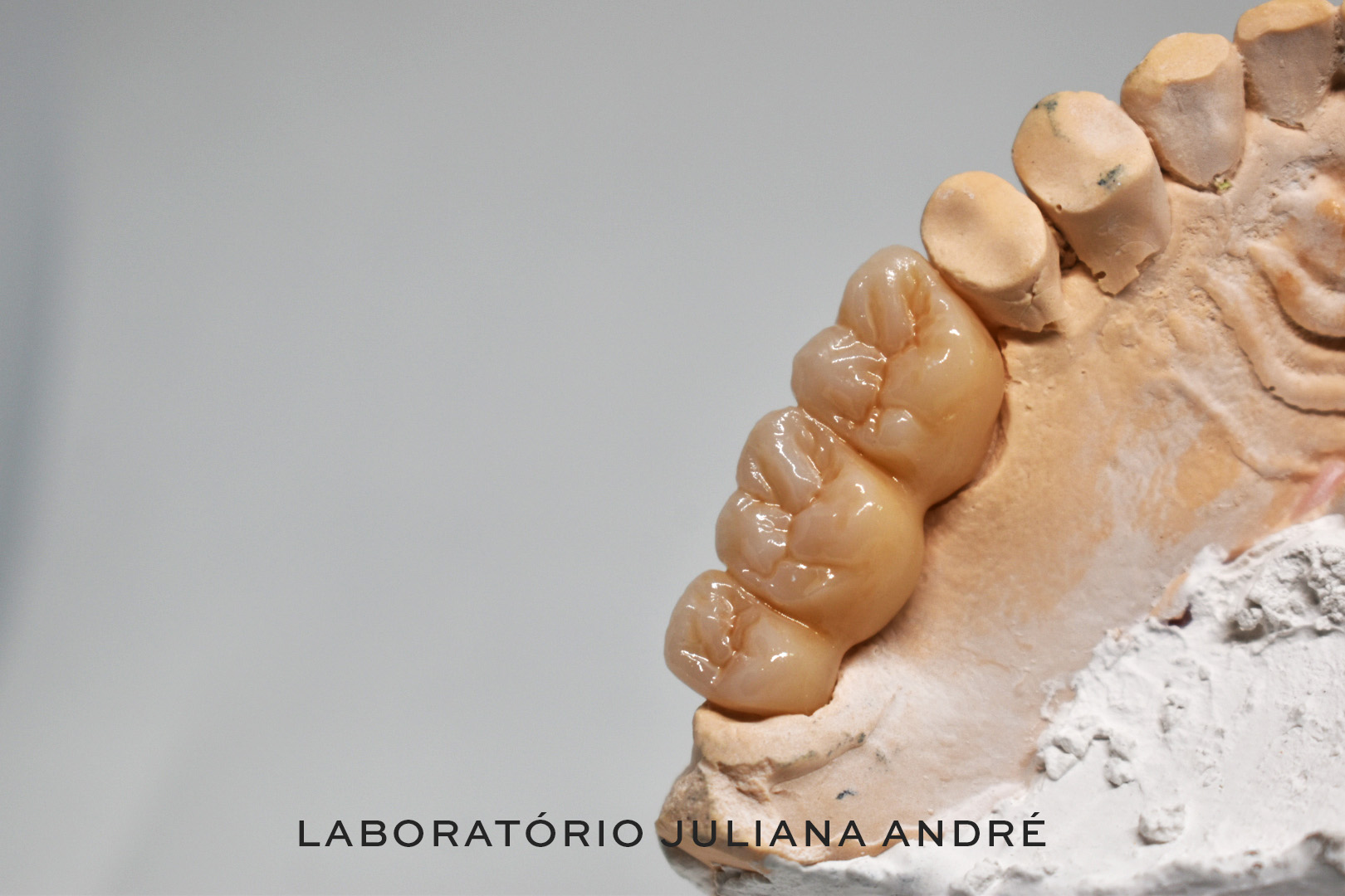 Ponte de 3 elementos em Zirconia maquilhada